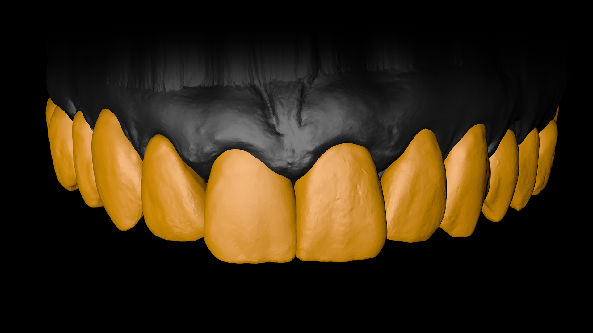 Fundamentals of Exocad Dental Design