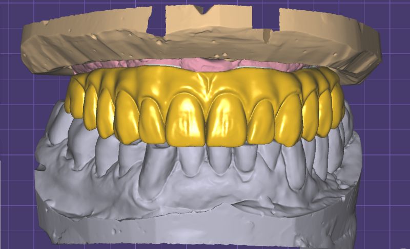 Exocad Implant Module