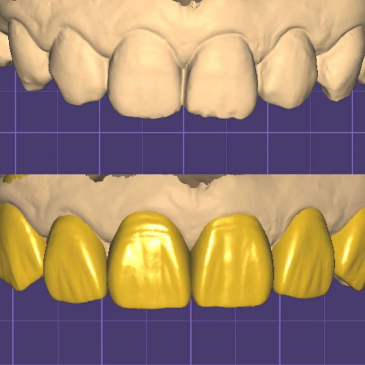 Exocad Designs for Manufacturing