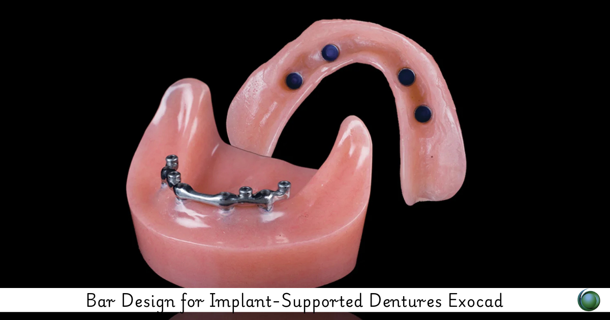 Bar Design for Implant-Supported Dentures Exocad