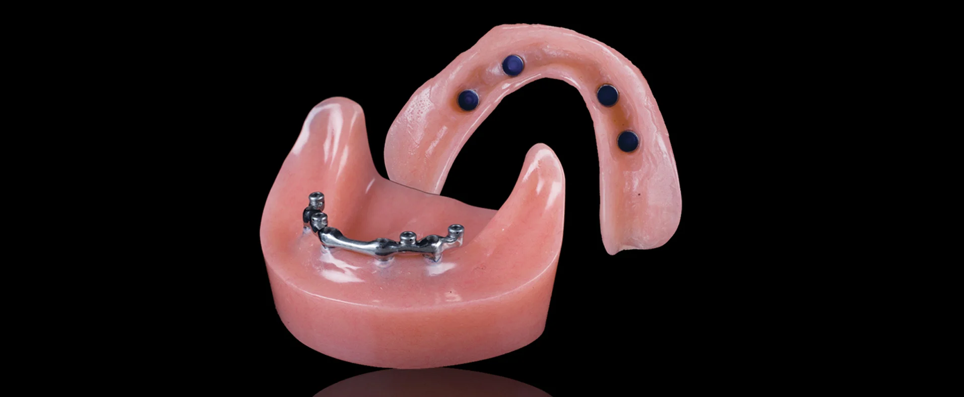 Bar Design for Implant-Supported Dentures