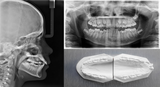 Orthodontic Treatment in Exocad