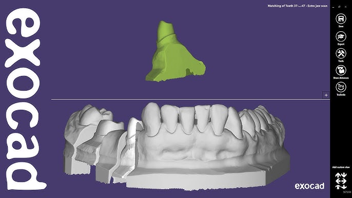 Exocad Integration with 3D Scanners