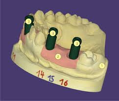 Abutment Design with Exocad