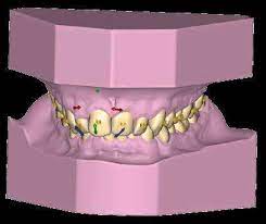 Dentures with Exocad