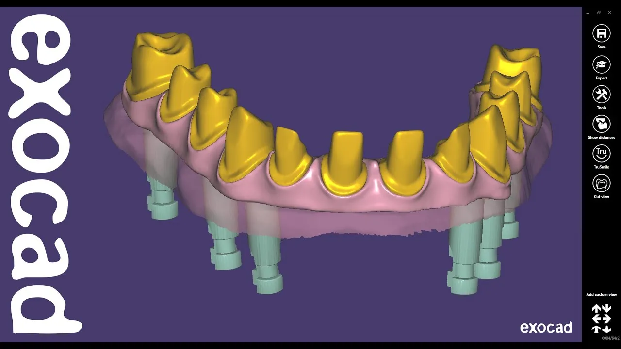 Optimization with Exocad