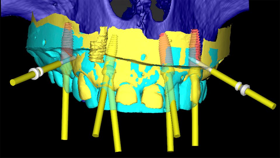 Exoplan Implant Planning